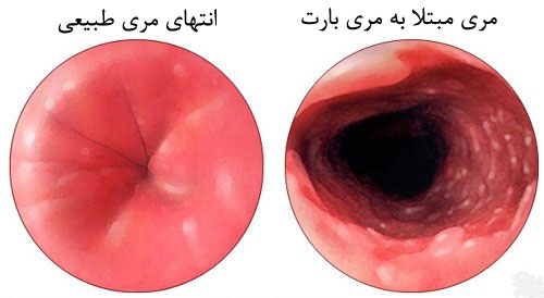 مری بارت