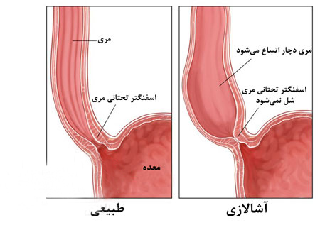 دریچه استفن تحتانی مری