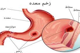 زخم معده