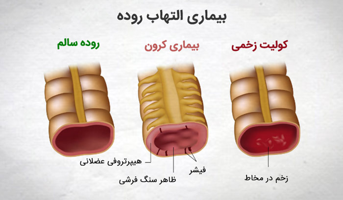 ضخم روده