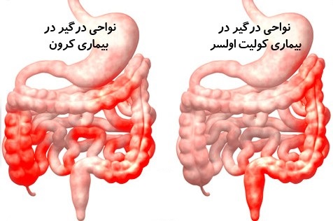 کولیت روده