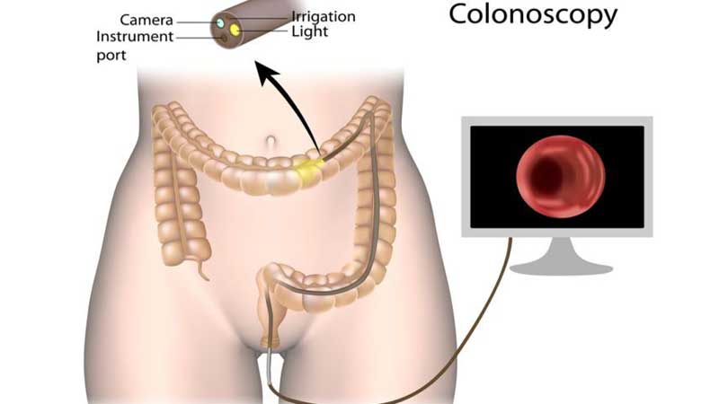 کولونوسکوپی